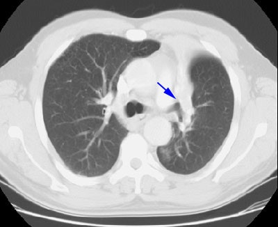 健康・医学 Thoracic Tumours Tumor-derived exosomal CCT6A serves as a matchmaker